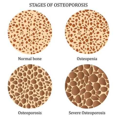 Osteoporosis